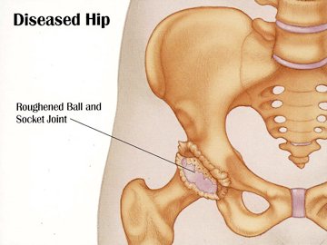 Diseased Hip