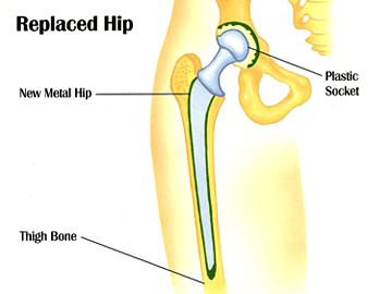 Replaced Hip