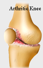 Arthritic Knee